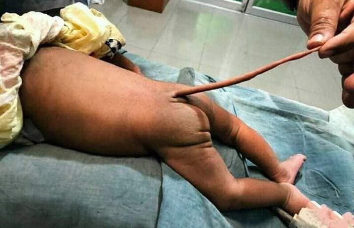¡Sorprendente! Un bebé nace con una cola