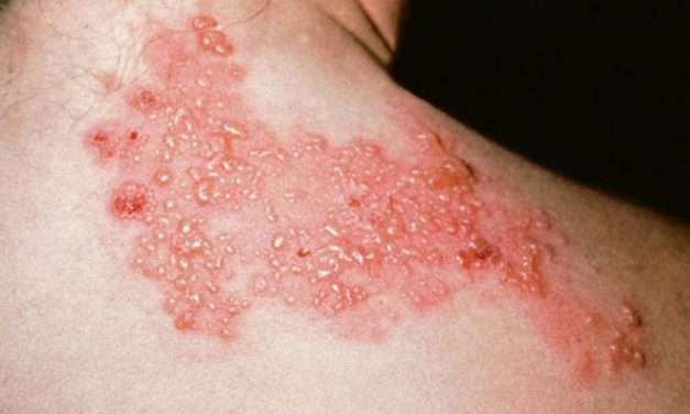 La Culebrilla: una enfermedad activada por el estrés