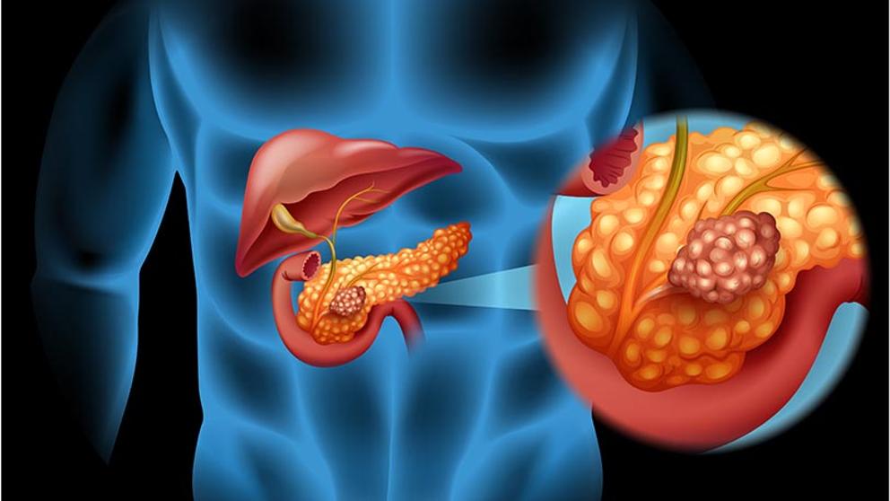 Cáncer de páncreas: mezcla de dos fármacos elimina células cancerosas