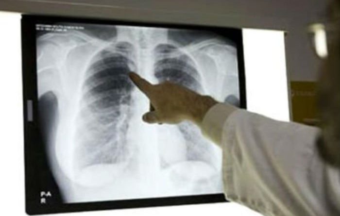 tuberculosis