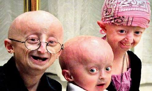 Un causante del síndrome de progeria de Hutchinson-Gilford en 3D