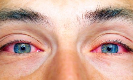 Salud: Conozca 19 causas de los ojos rojos y sus diferentes tratamientos