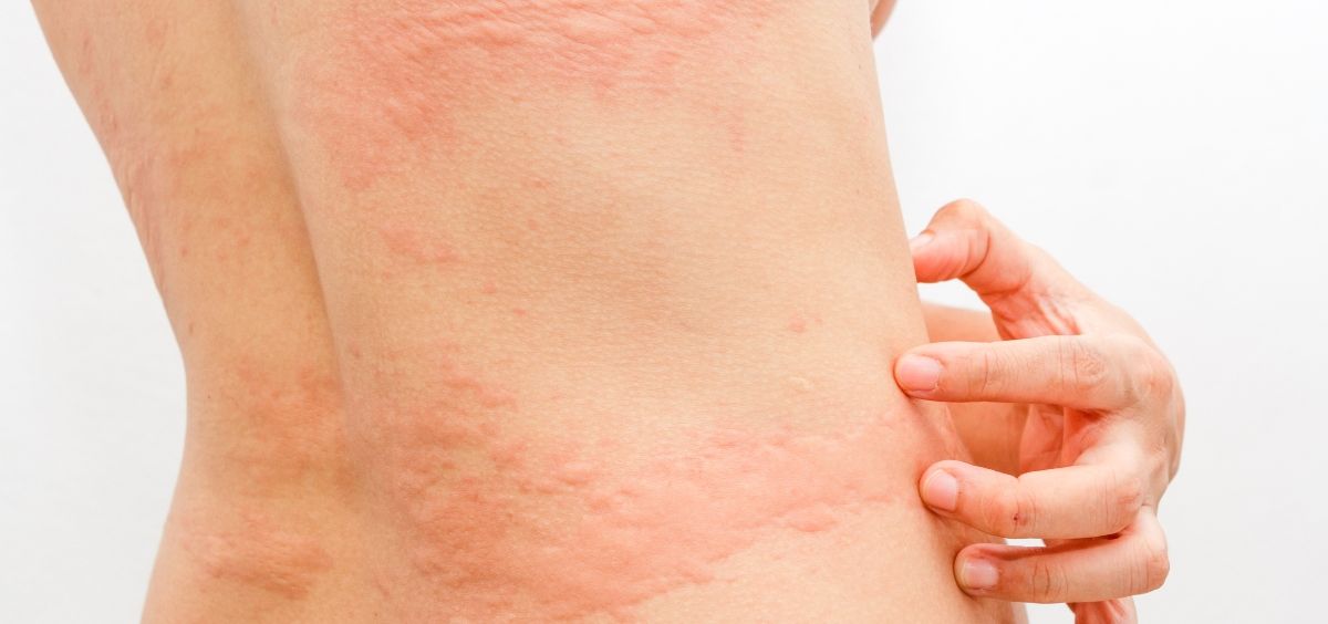 Coronavirus: Conozca las cinco manifestaciones del Covid-19 en la piel