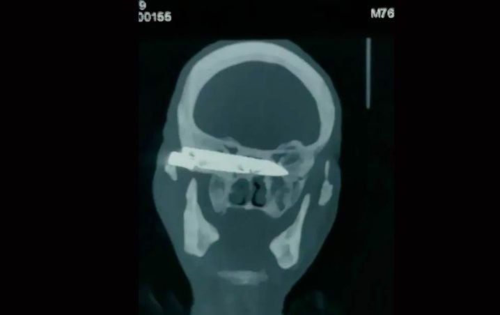 Extraen un cuchillo del cráneo de un hombre, que fue herido hace 26 años