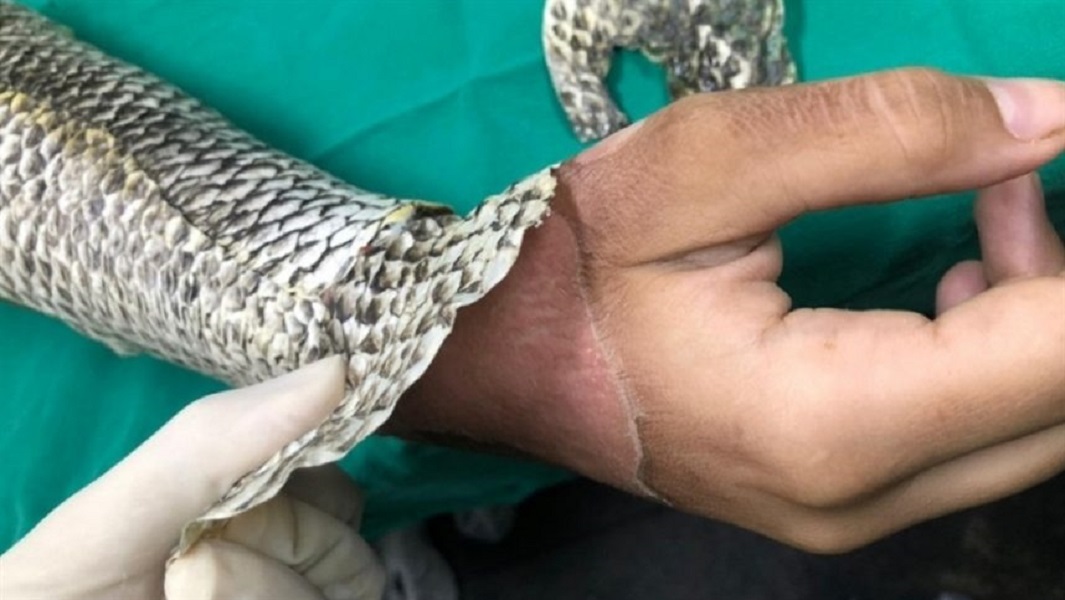 Explosión en Beirut: Brasil donará piel de tilapia para tratar a los heridos