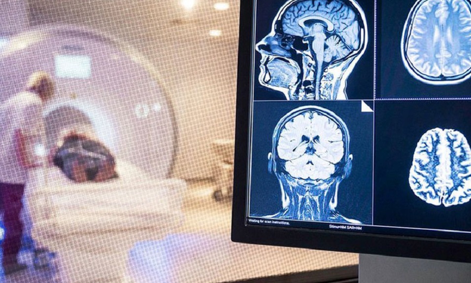 Covid-19: El cerebro de pacientes recuperados podría envejecer diez años