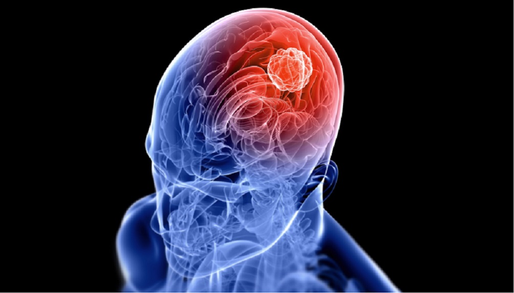 Israel: tecnología de “nano-bala” dispara al cáncer de cerebro
