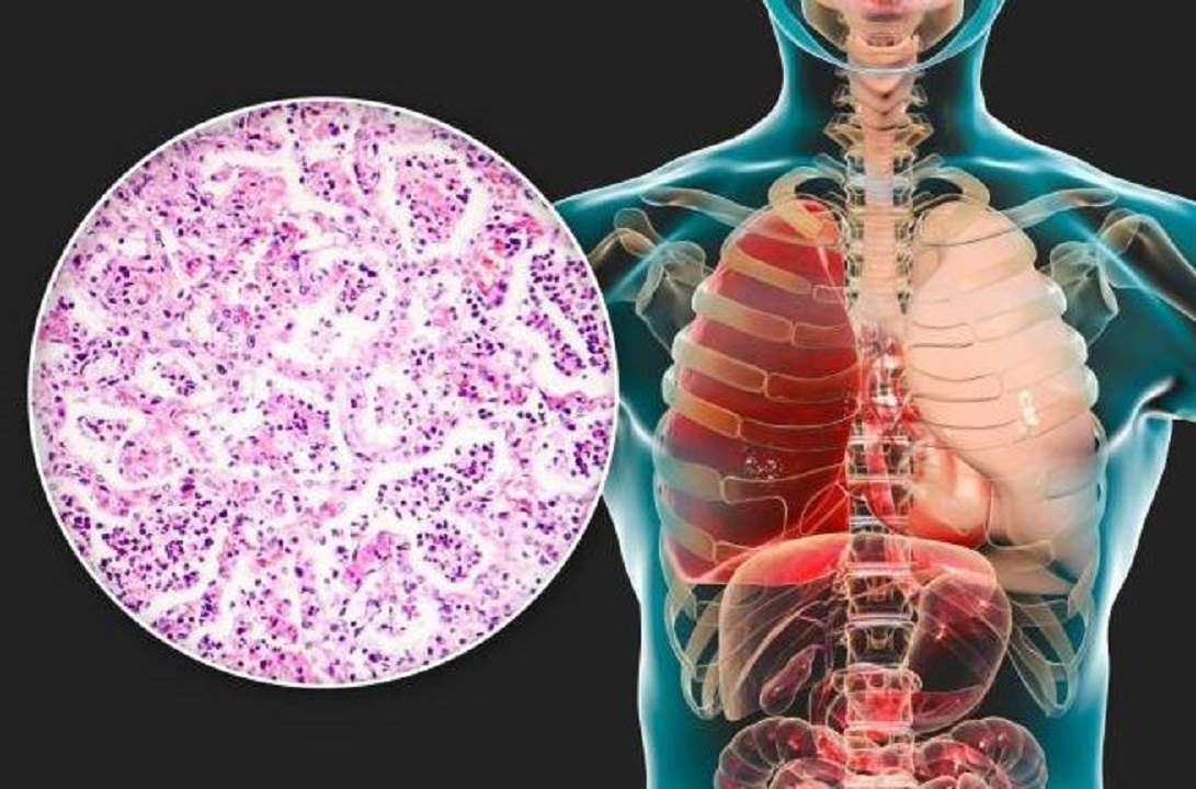 Salud: enfermedad neumocócica, síntomas y complicaciones