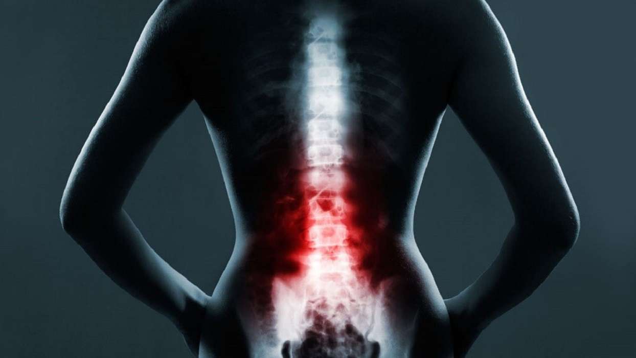 Espondilitis: conoce esta enfermedad poco común, sus síntomas y causas