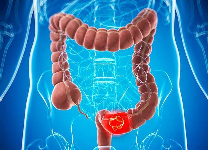 Colitis ulcerosa