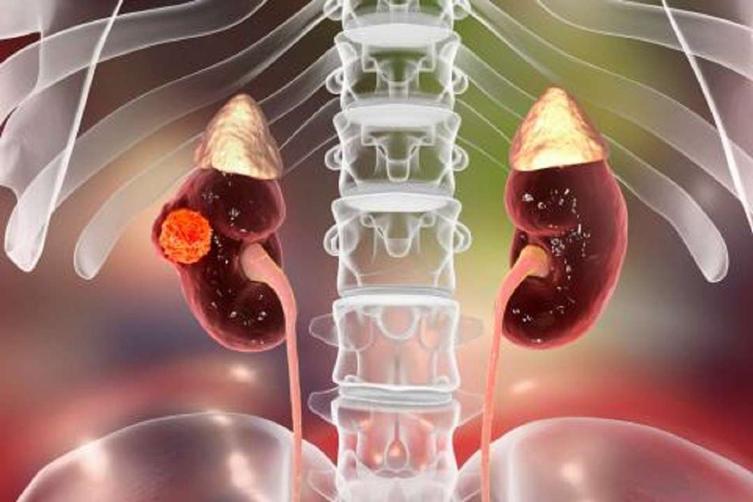 Cáncer de riñón: terapia con frío, una solución efectiva frente a este mal