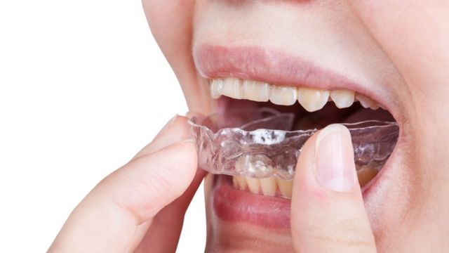 Bruxismo: Rechinar los dientes