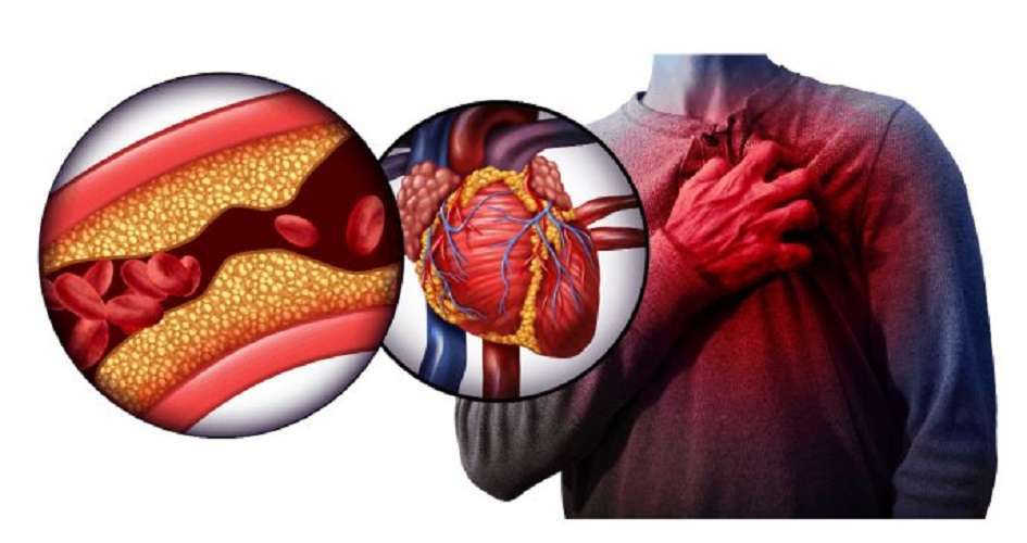 Infarto