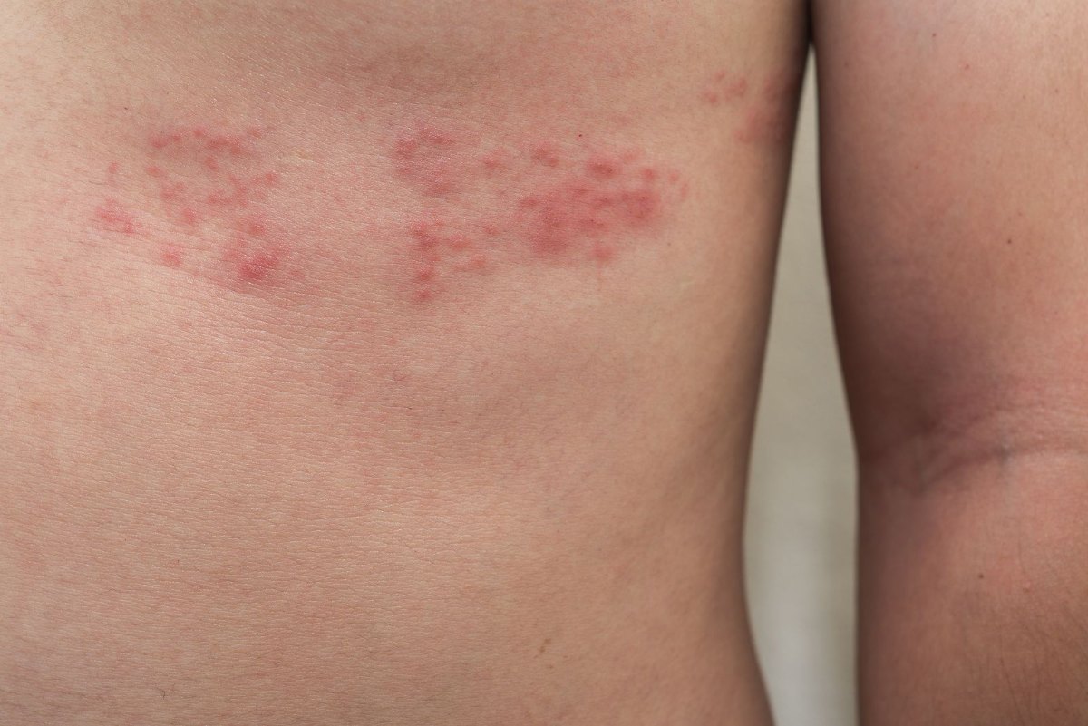Herpes