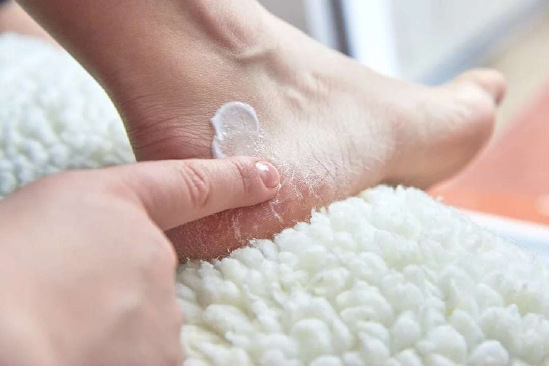 Talones agrietados: cómo revitalizarlos con esta mascarilla de cambur