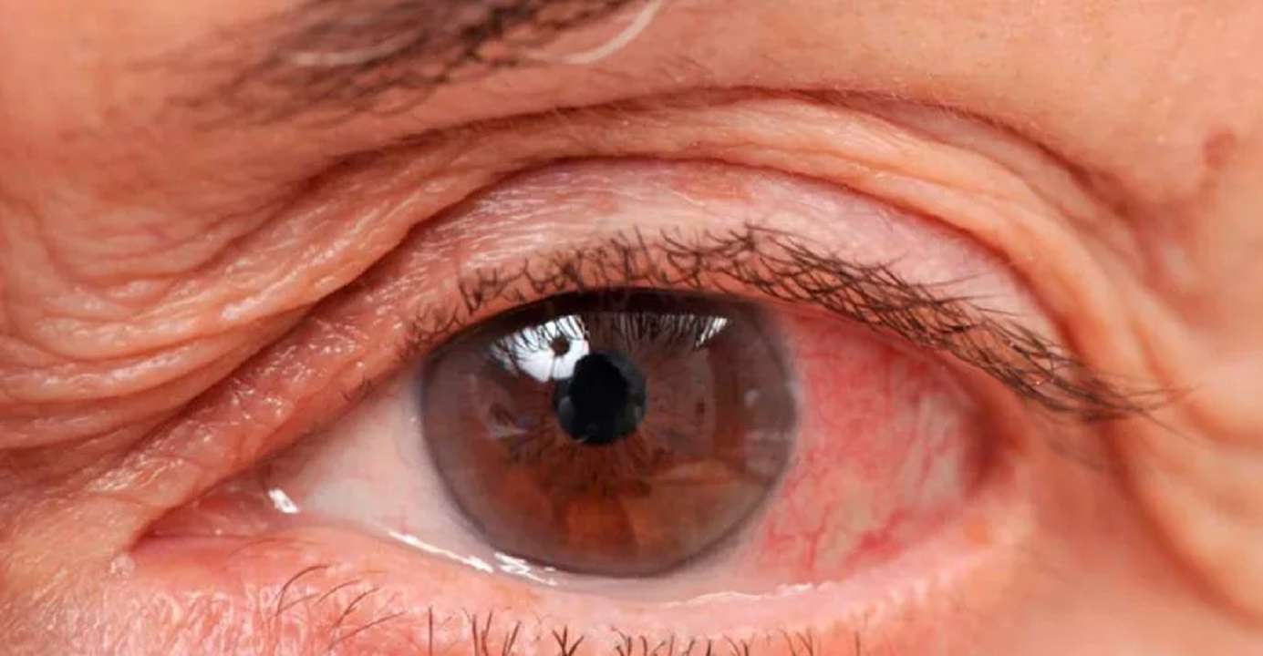 Glaucoma: conoce cómo tratar esta pérdida gradual de la vista