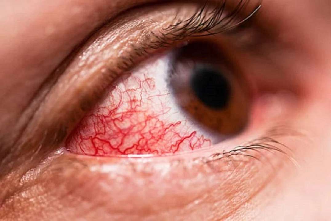 Infecciones en los ojos: combatelas con estos remedios caseros