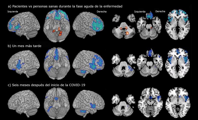 coronavirus y cambios en el cerebro