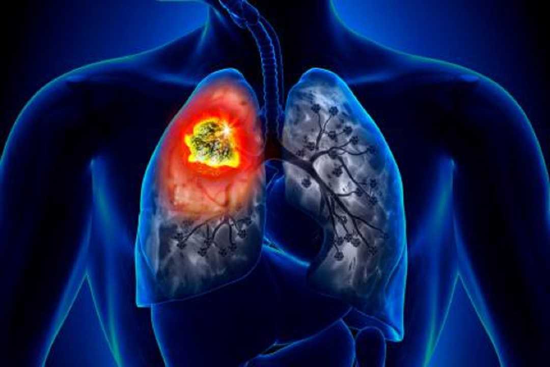 Cáncer de pulmón: conoce los signos que lo delatan en su inicio temprano