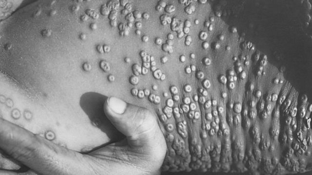 gates predijo viruela del mono