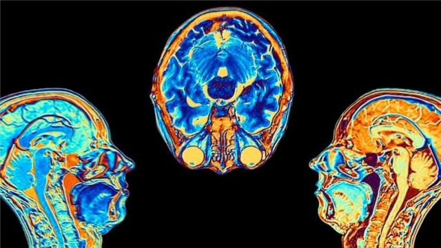 Covid y cerebro
