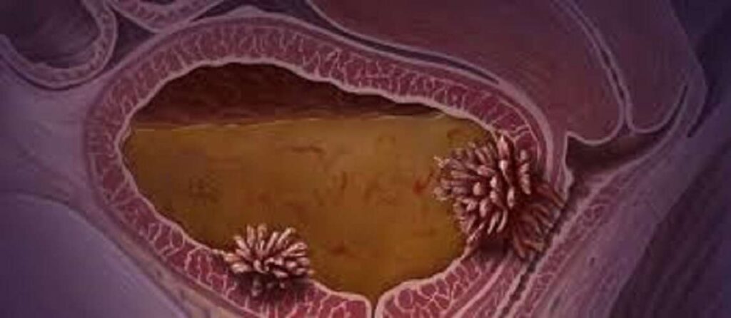 Cáncer de vejiga