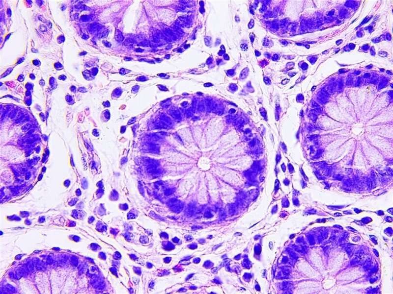 Cáncer de colon