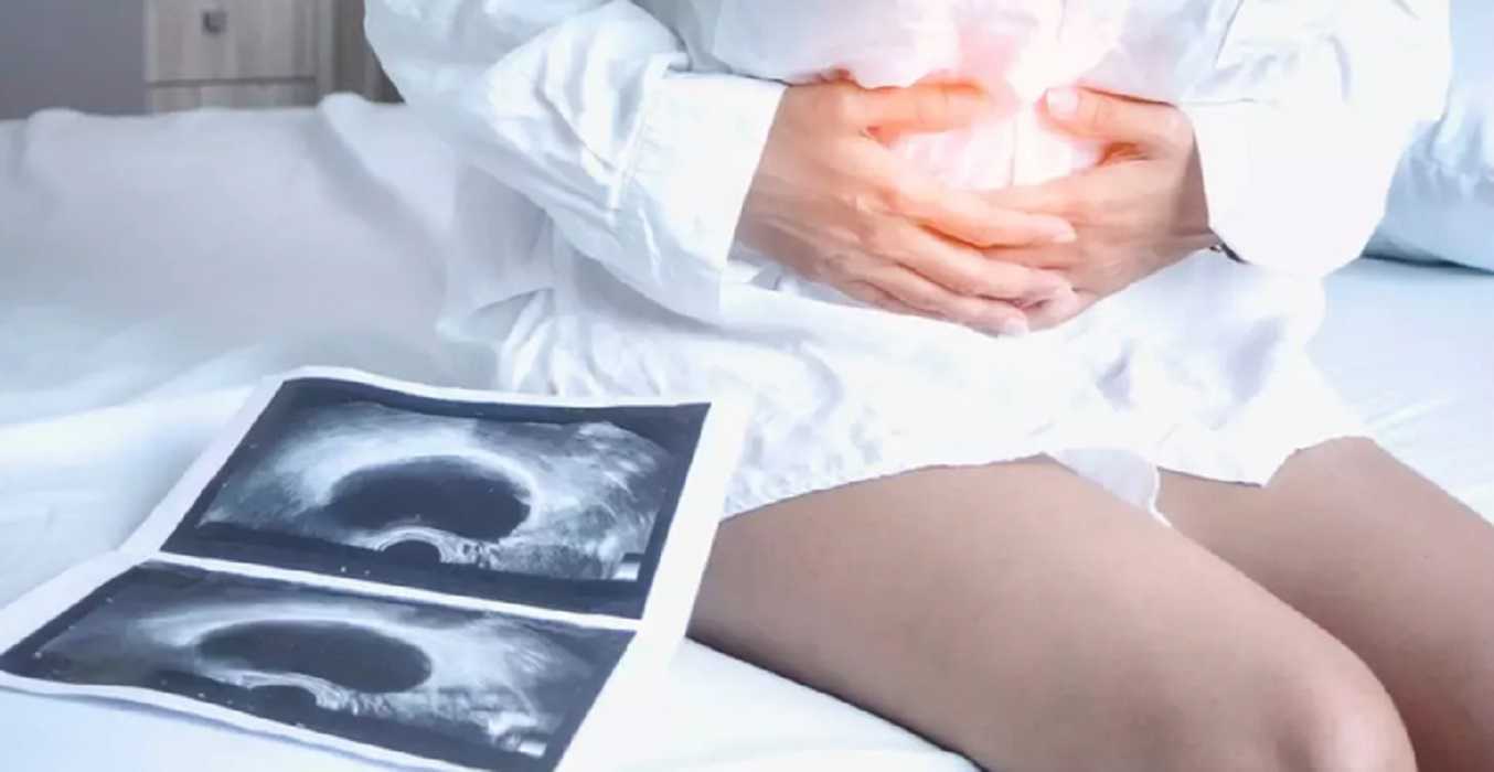 Endometriosis: conoce qué es, causa y síntomas