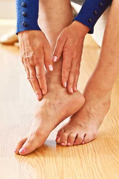 Ajo para aliviar las varices