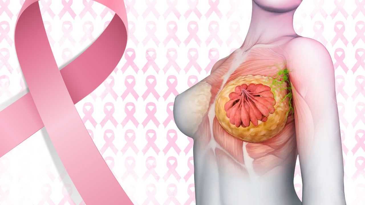 Cáncer de mama: conoce cuántos tipos existen
