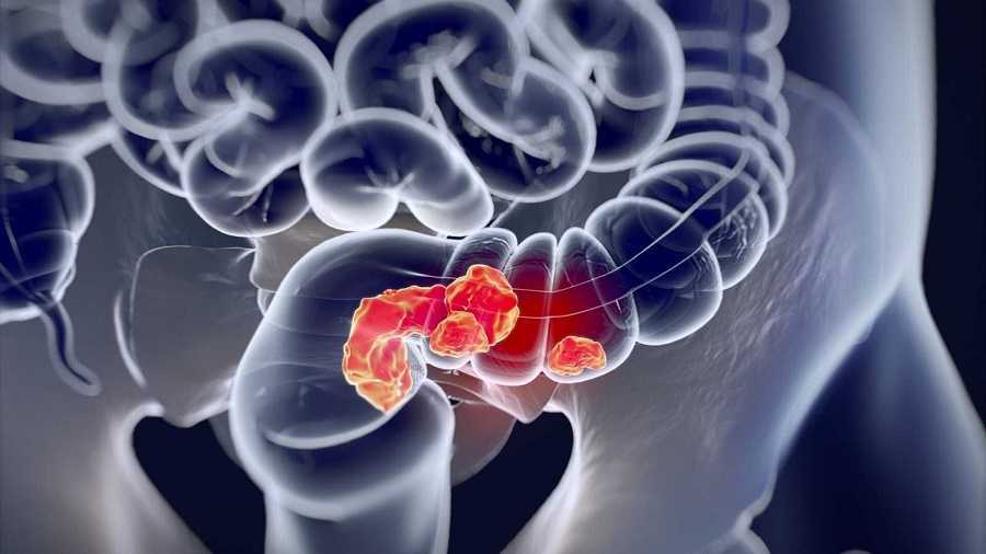 No sufras de cáncer de colon / Dr. Carlos Jaramillo