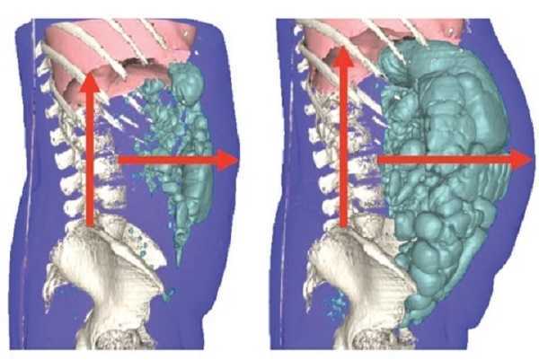 distensión abdominal 