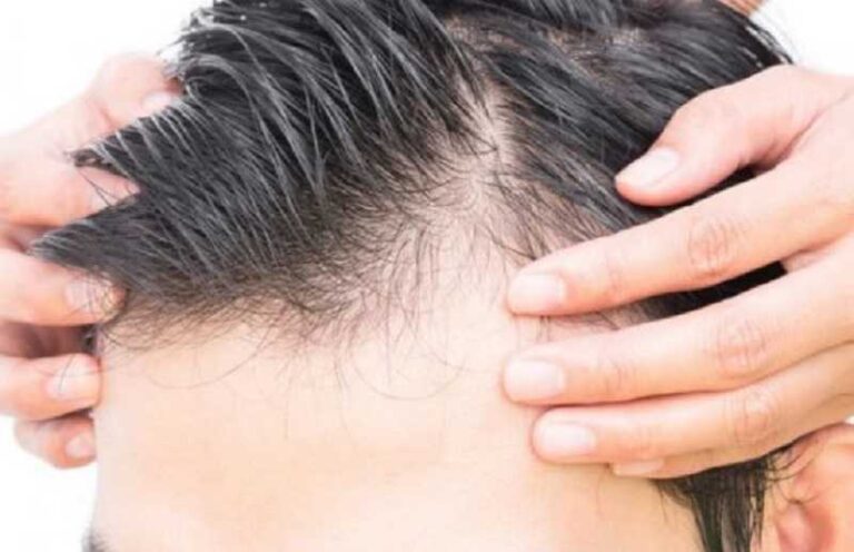 Recupera tu pelo con ciencia: qué funciona y qué no