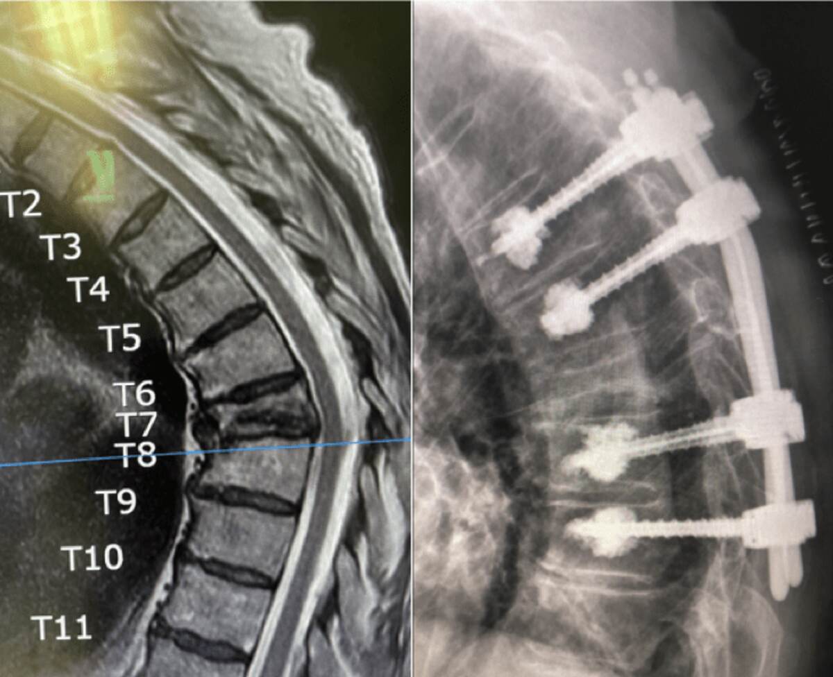 Juan Yucra Cayata requiere intervención quirúrgica