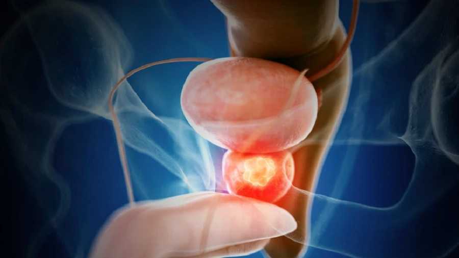 Cáncer de próstata, así puedes prevenirlo