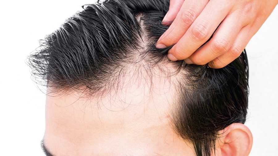 5 secretos para vencer la calvicie en 92 días