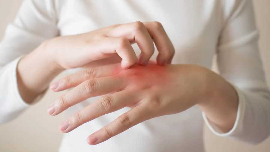 La alergia