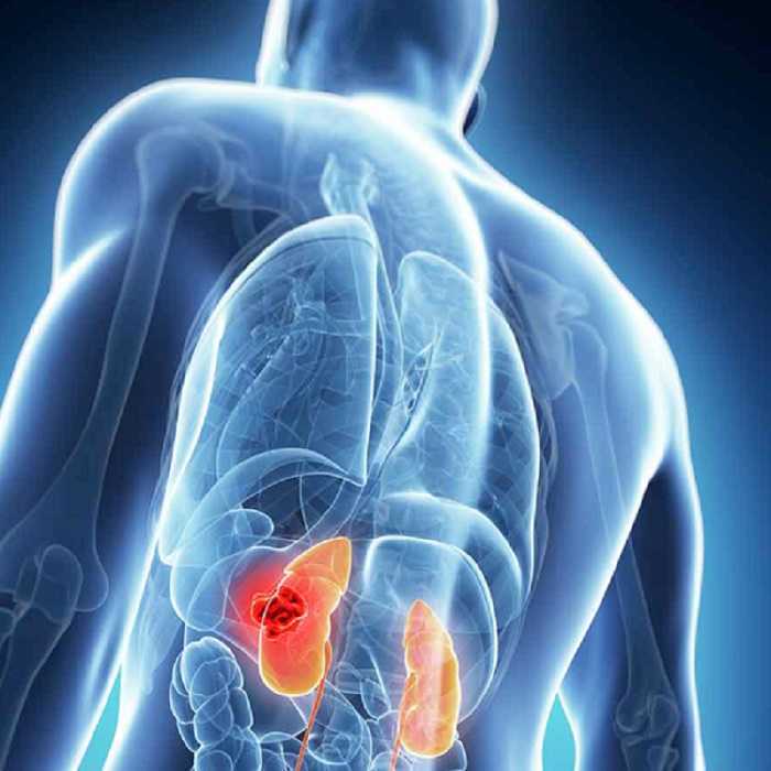 Cuida tus riñones | Evita la insuficiencia renal así