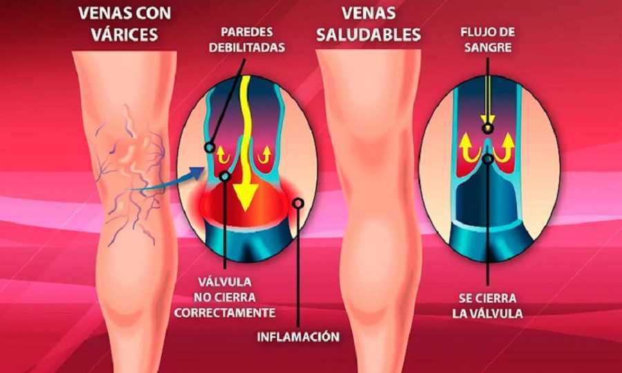 Cinco claves para evitar las varices