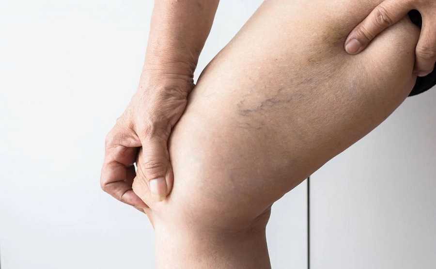 Cinco claves para evitar las varices hoy mismo