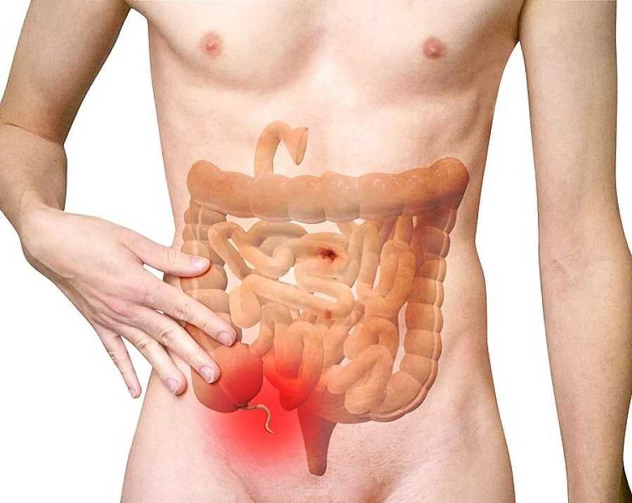 Apendicitis: ¿Operación o remedios milagrosos?