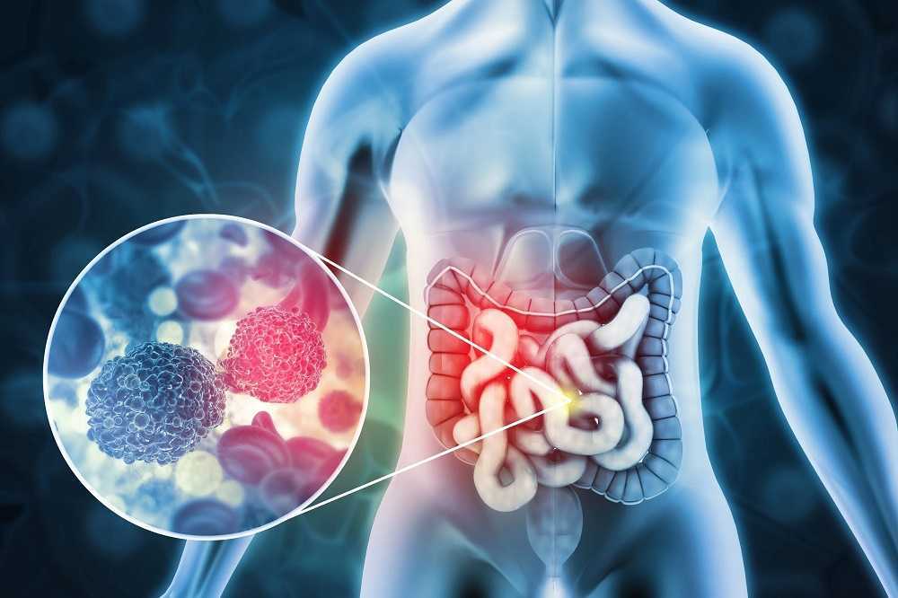Cáncer de colon: señales de alarma
