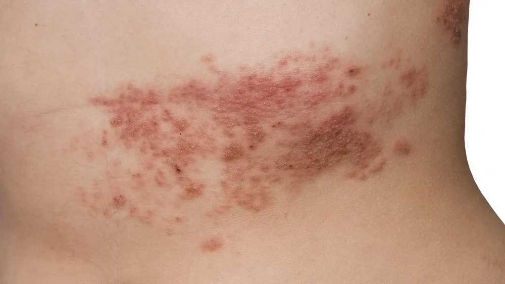 Culebrilla