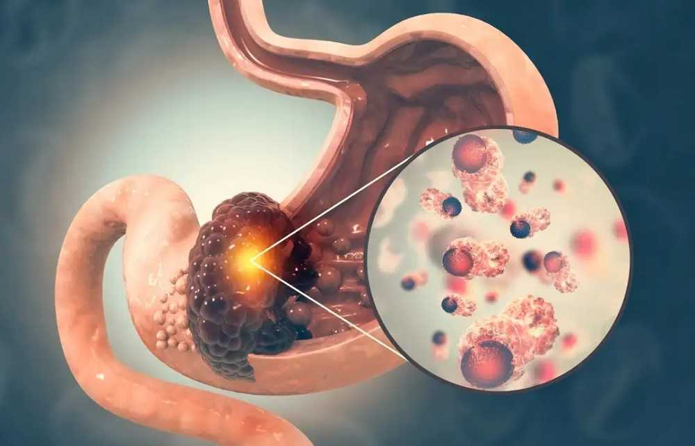 ¡Todos los signos de cáncer de estómago!