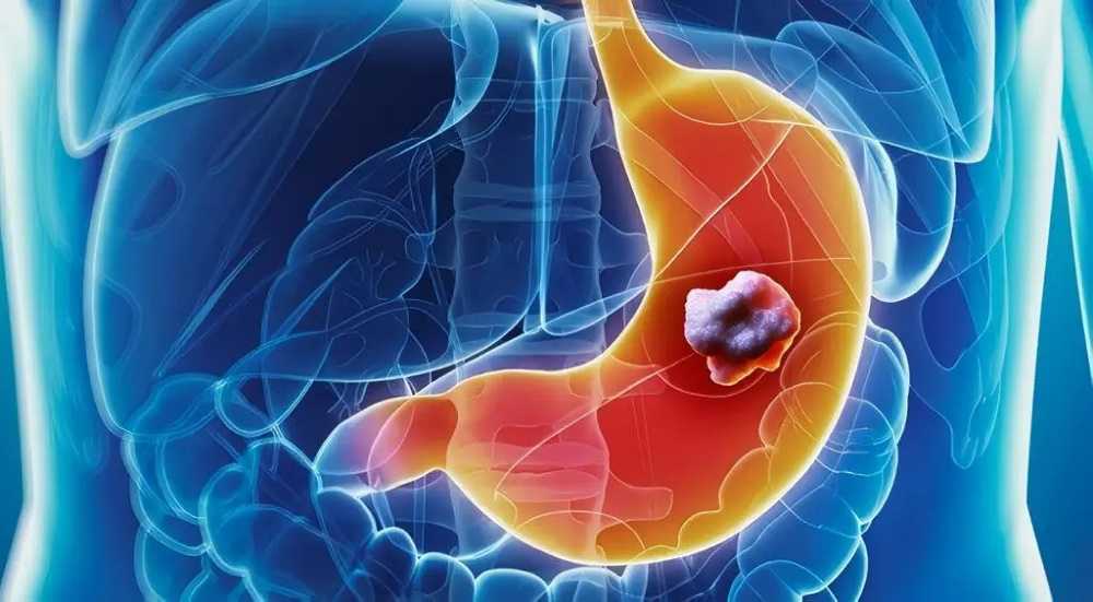 Todos los signos de cáncer de estómago