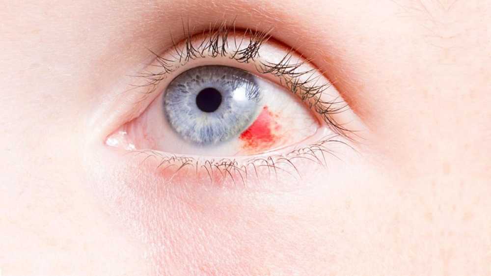 ¿Por qué ocurren los derrames oculares? 