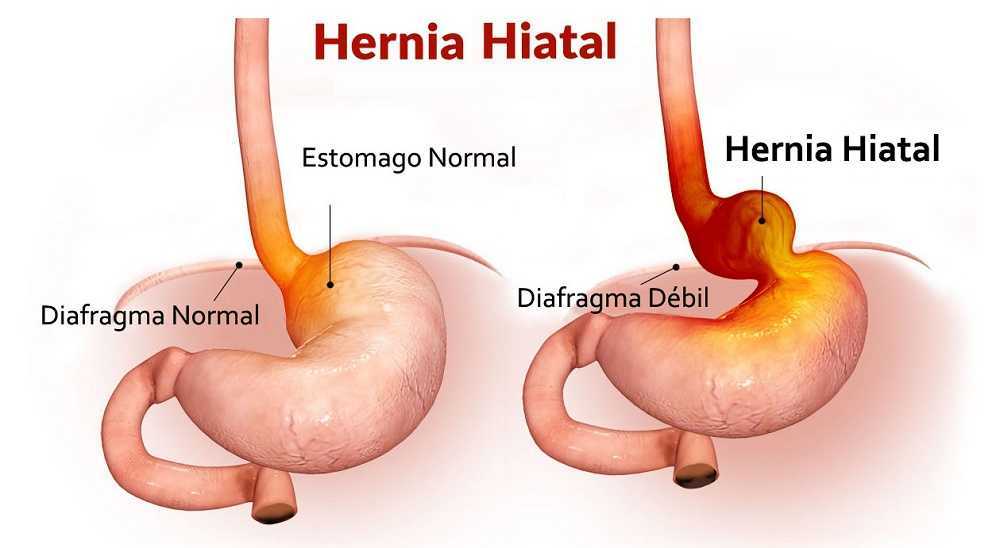 Hernia de hiato