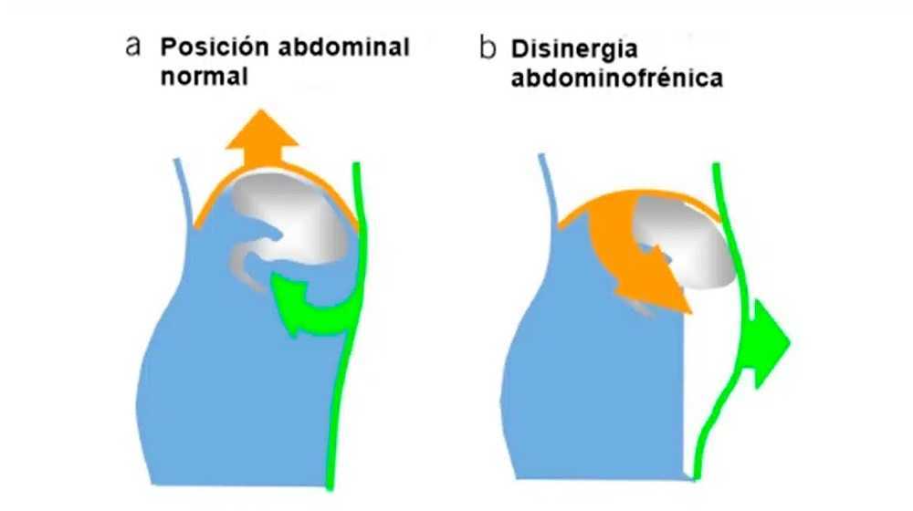 Distensión abdominal