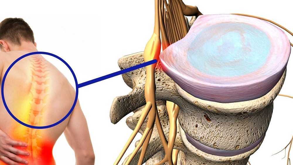 Tu espalda cuando tienes una hernia