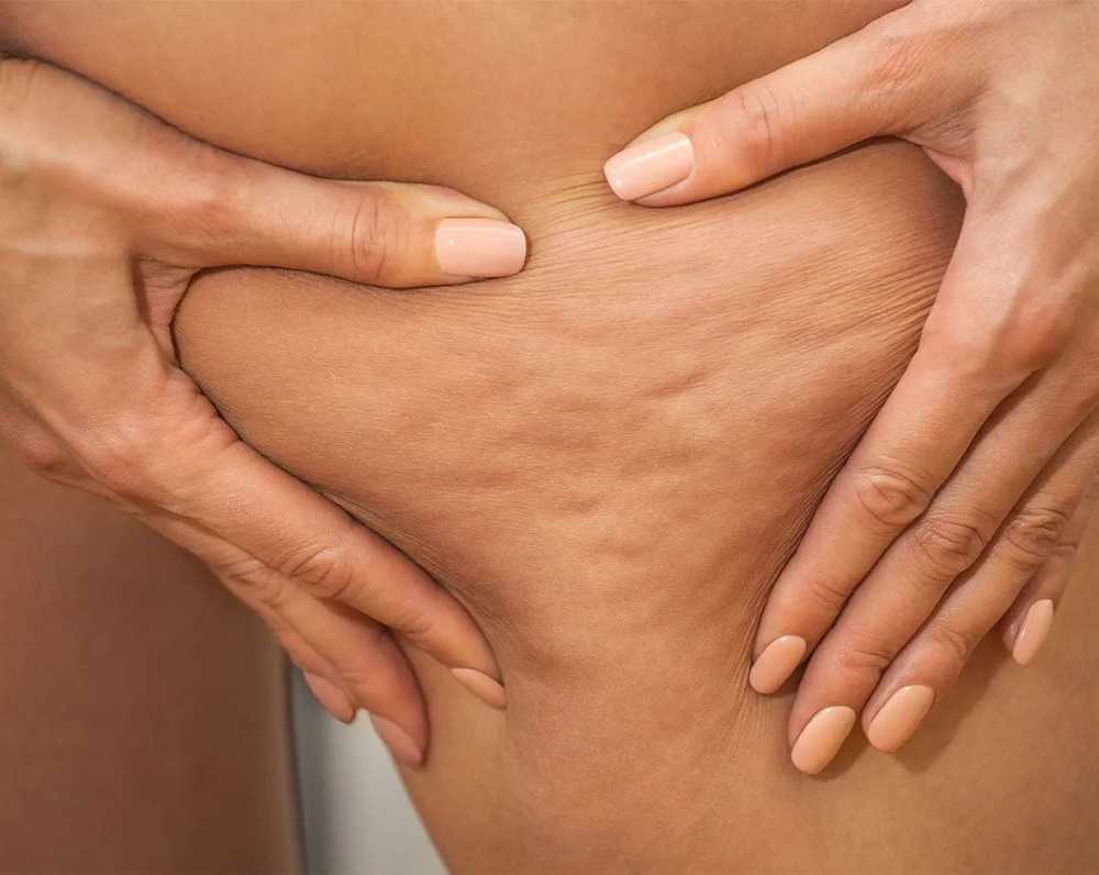 Eliminar la grasa de las piernas